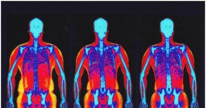 DEXA Scan
